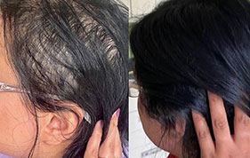 Before and after hair growth improvement image on padma home page
