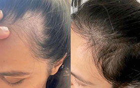Before and after hairline hair growth image on padma home page