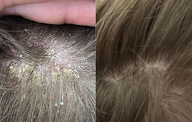 Before and after scalp with reduced flaking image on padma home page