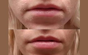 Before and after of dry, chapped lips image on padma home page