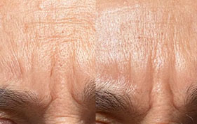 Before and after of  forehead wrinkles reduced image on padma home page