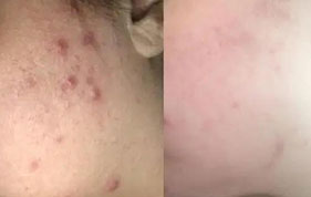 Before and after acne reduction on cheek image on padma testimonials page
