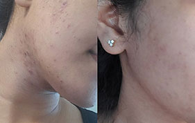 Before and after of acne-prone skin improvement image on padma home page