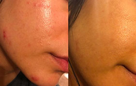 Before and after clearer facial skin image on padma home page