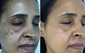 Before and after hyperpigmentation treatment. image on padma testimonials page