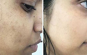 Before and after clearer facial patches image on padma testimonials page