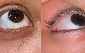 Before and after under-eye crease appearance image on padma testimonials page