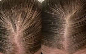 Before and after thicker hair appearance image on padma testimonials page
