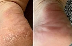 Before and aftersmoother heel skin image on padma testimonials page