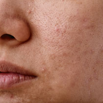 Close-up of skin with visible pores and minor blemishes image on padma home page