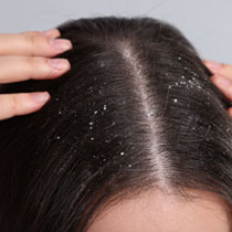 Hands in hair with visible dandruff flakes image on padma home page
