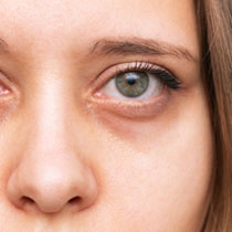 Close-up of an eye with dark under-eye circles image on padma home page