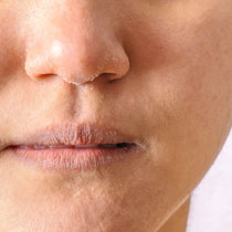 Close-up of dry, flaky skin around nose and lips image on padma home page
