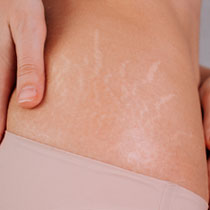 Hands gently holding skin with visible stretch marks image on padma home page