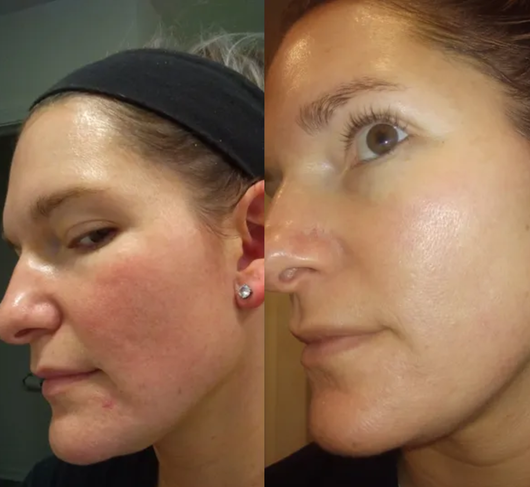 Before and after face improvement image on padma home page