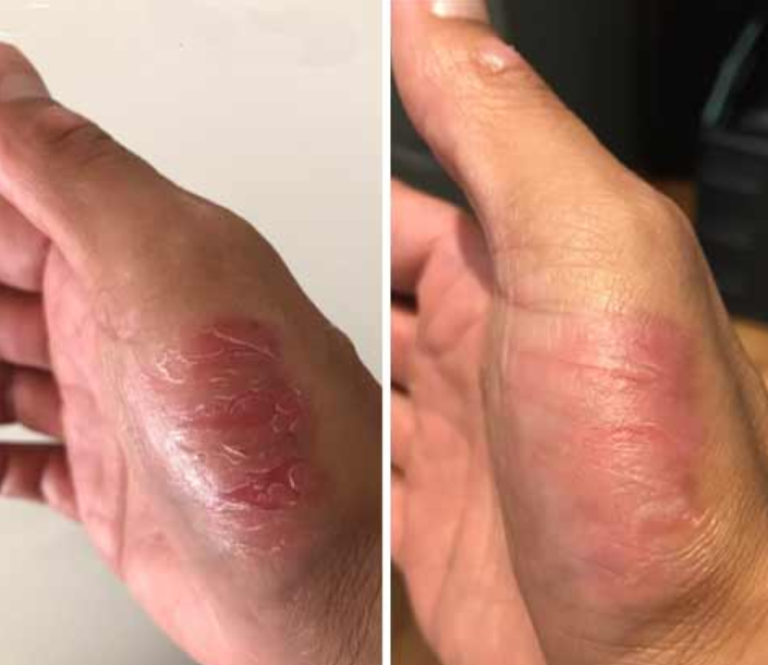 Before and after Hand appearance image on padma testimonials page